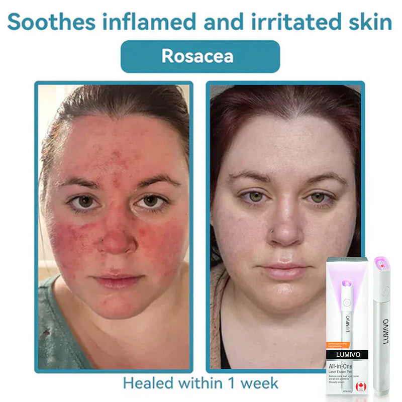 LUMIVO™ All-in-One CO₂ Laser Eraser Pen | Removes Moles, Warts, Skin Flaws & Pigmentation