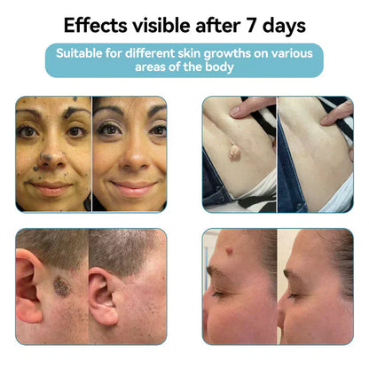 LUMIVO™ All-in-One CO₂ Laser Eraser Pen | Removes Moles, Warts, Skin Flaws & Pigmentation