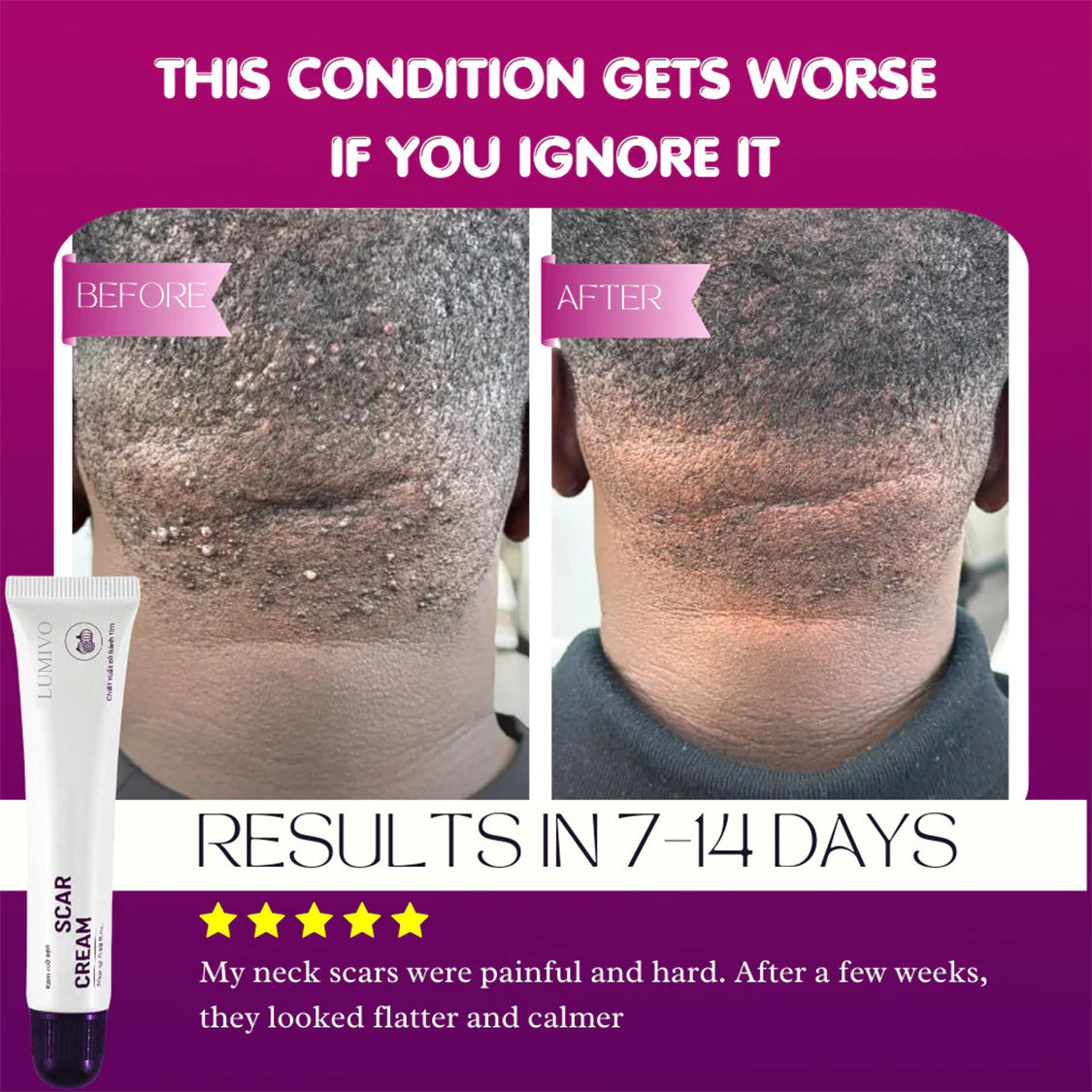 LUMIVO Scar Cream – Advanced Treatment for Raised & Keloid Scars