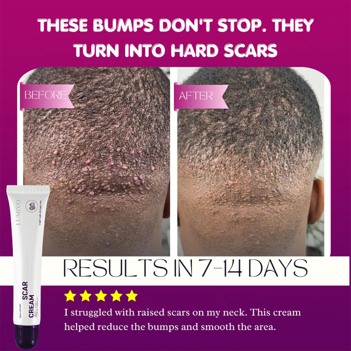 LUMIVO Scar Cream – Advanced Treatment for Raised & Keloid Scars