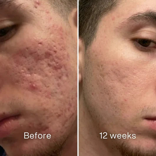 Clinical Acne Scar Remodeling Stick