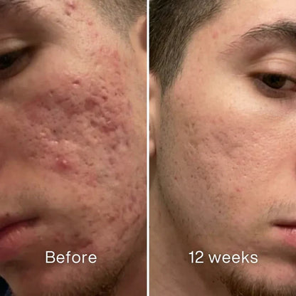 Clinical Acne Scar Remodeling Stick