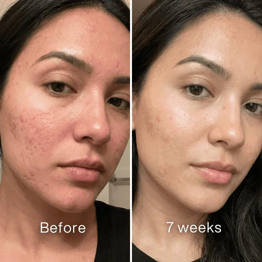 Clinical Acne Scar Remodeling Stick