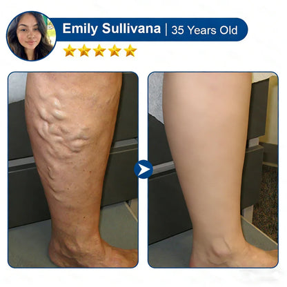 LUMIVO™ 𝑽𝗲𝗶𝙣 𝘾𝐨𝐧𝘁𝗼𝙪𝙧 𝙈𝙞𝐜𝐫𝒐𝒏𝒆𝗲𝗱𝗹𝙚 𝙋𝙖𝐭𝐜𝒉 𝒘𝒊𝘁𝗵 𝗔𝙙𝙫𝙖𝙣𝙘𝐞𝐝 𝐃𝒊𝒐𝒔𝗺𝙞𝐧 & 𝑯𝒆𝘀𝗽𝗲𝙧𝙞𝙙𝙞𝐧 𝐃𝒆𝒍𝒊𝒗𝗲𝗿𝙮🌿𝟕-𝐃𝐚𝐲 𝐕𝐢𝐬𝐢𝐛𝐥𝐞 𝐑𝐞𝐬𝐮𝐥𝐭𝐬 𝐟𝐨𝐫 𝐕𝐚𝐫𝐢𝐜𝐨𝐬𝐞 𝐕𝐞𝐢𝐧𝐬