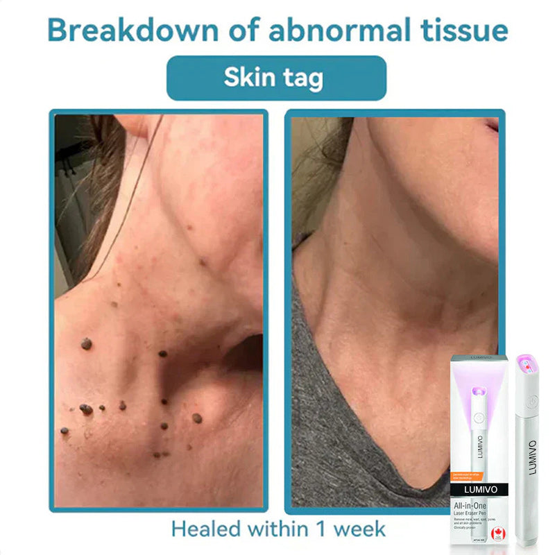 LUMIVO™ All-in-One CO₂ Laser Eraser Pen | Removes Moles, Warts, Skin Flaws & Pigmentation