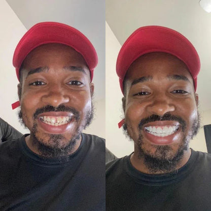 LUMIVO™ Clip-on Veneers