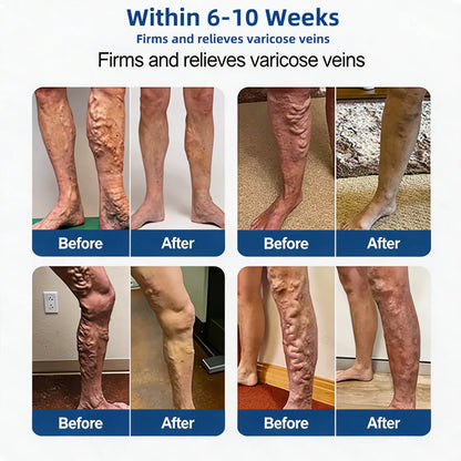 LUMIVO™ 𝑽𝗲𝗶𝙣 𝘾𝐨𝐧𝘁𝗼𝙪𝙧 𝙈𝙞𝐜𝐫𝒐𝒏𝒆𝗲𝗱𝗹𝙚 𝙋𝙖𝐭𝐜𝒉 𝒘𝒊𝘁𝗵 𝗔𝙙𝙫𝙖𝙣𝙘𝐞𝐝 𝐃𝒊𝒐𝒔𝗺𝙞𝐧 & 𝑯𝒆𝘀𝗽𝗲𝙧𝙞𝙙𝙞𝐧 𝐃𝒆𝒍𝒊𝒗𝗲𝗿𝙮🌿𝟕-𝐃𝐚𝐲 𝐕𝐢𝐬𝐢𝐛𝐥𝐞 𝐑𝐞𝐬𝐮𝐥𝐭𝐬 𝐟𝐨𝐫 𝐕𝐚𝐫𝐢𝐜𝐨𝐬𝐞 𝐕𝐞𝐢𝐧𝐬