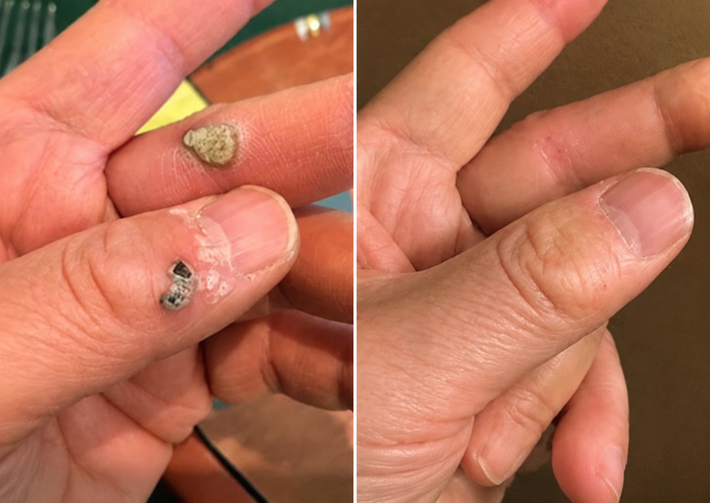 ✨Rainiste®2-in-1 Microneedle & Hydrocolloid Patch🍀| Removes Raised Moles, Acne, Flat Warts & Skin Tags | Helps Improve Wrinkles, Scars & Blemishes | Invisible Patches for Face & Body