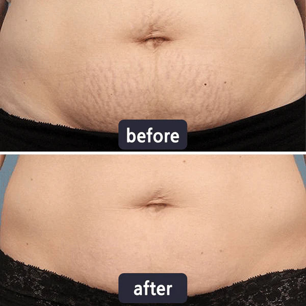 🔥Limited-time 60% sale--LUMIVO Scar Repair Cream — Smooth, Clear, Confident Skin