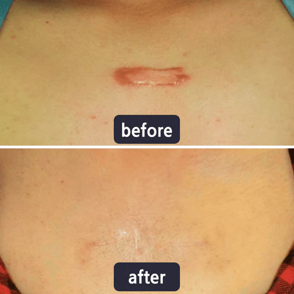 🔥Limited-time 60% sale--LUMIVO Scar Repair Cream — Smooth, Clear, Confident Skin