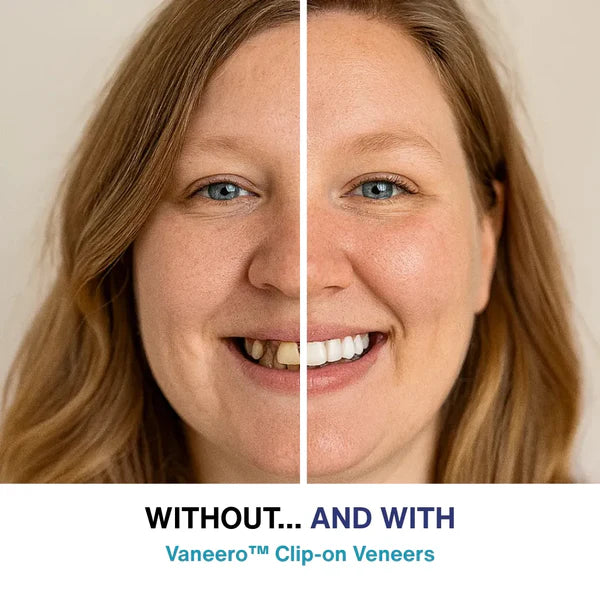 LUMIVO™ Clip-on Veneers