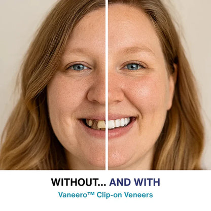 LUMIVO™ Clip-on Veneers
